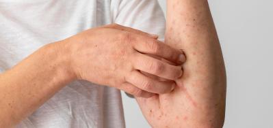 Sarampión: qué es, causas y síntomas clave para identificarlo